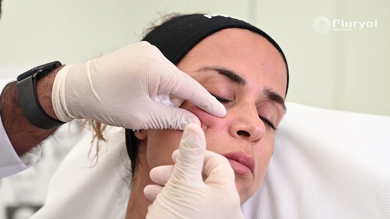 Achieve a volumized, restructured and moisturized skin with Pluryal Biofillers and contour Lidocaine