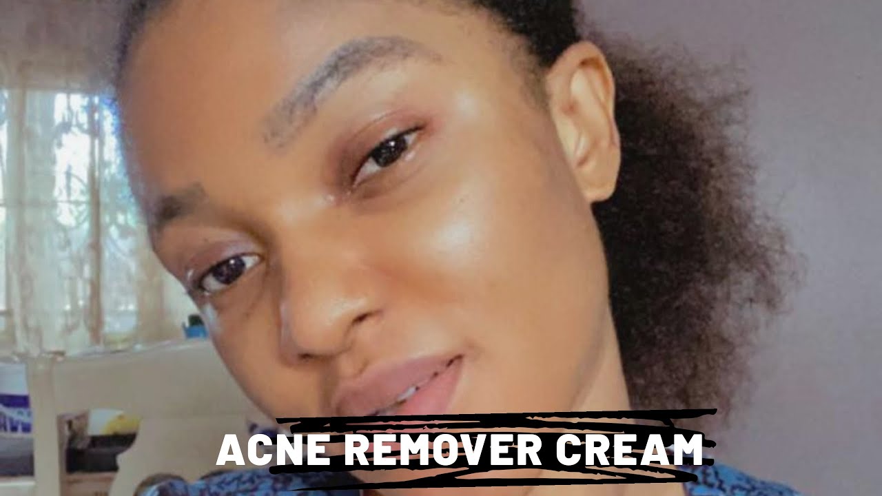Acne Remover Cream | Dark Spots Remover Cream