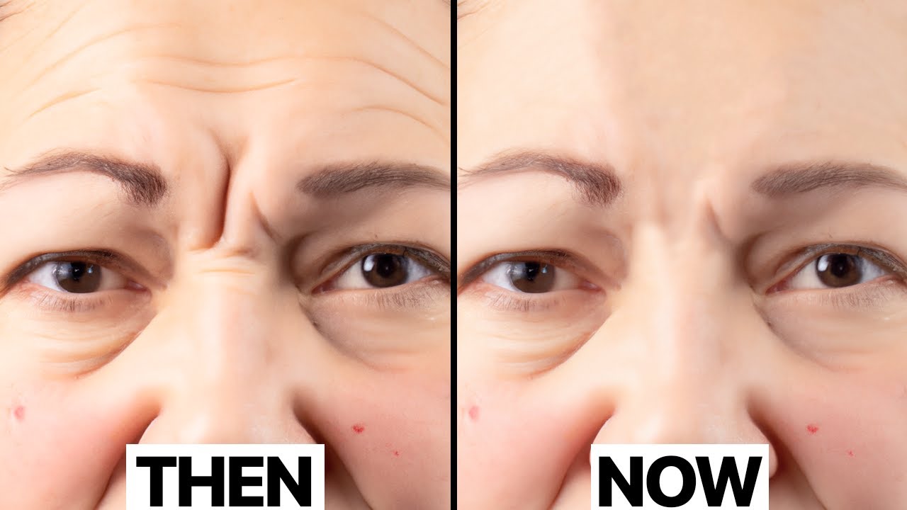 How To Soften Your Wrinkles | Neurotoxin Injections