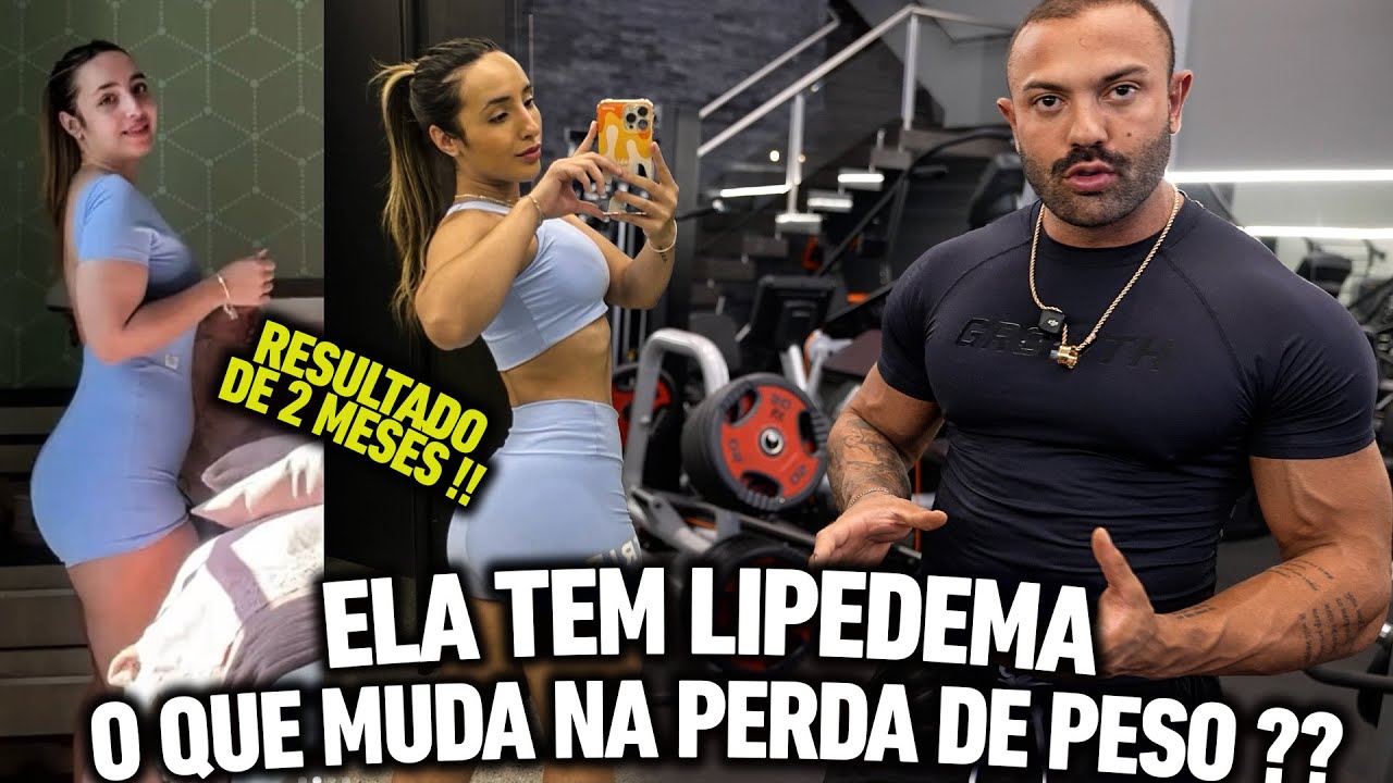 ELA TEM LIPEDEMA O QUE ISSO MUDA NA HORA DA PERDA DE PESO ???