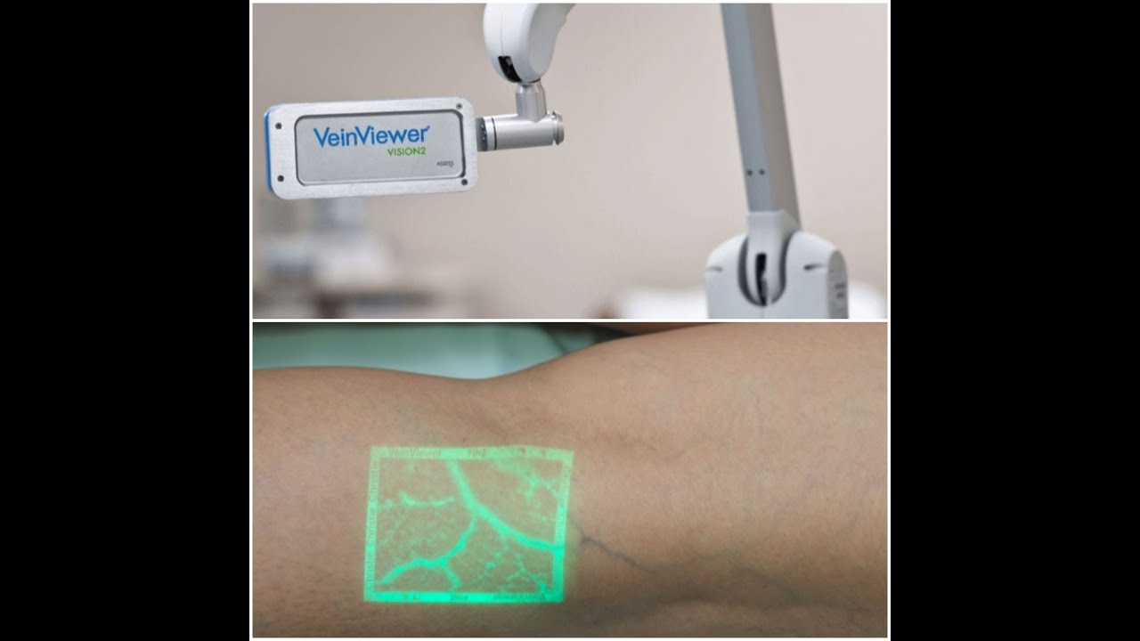 Vascular Online Training - Cryo Laser and Cryo Sclerotherapy (CLaCS)