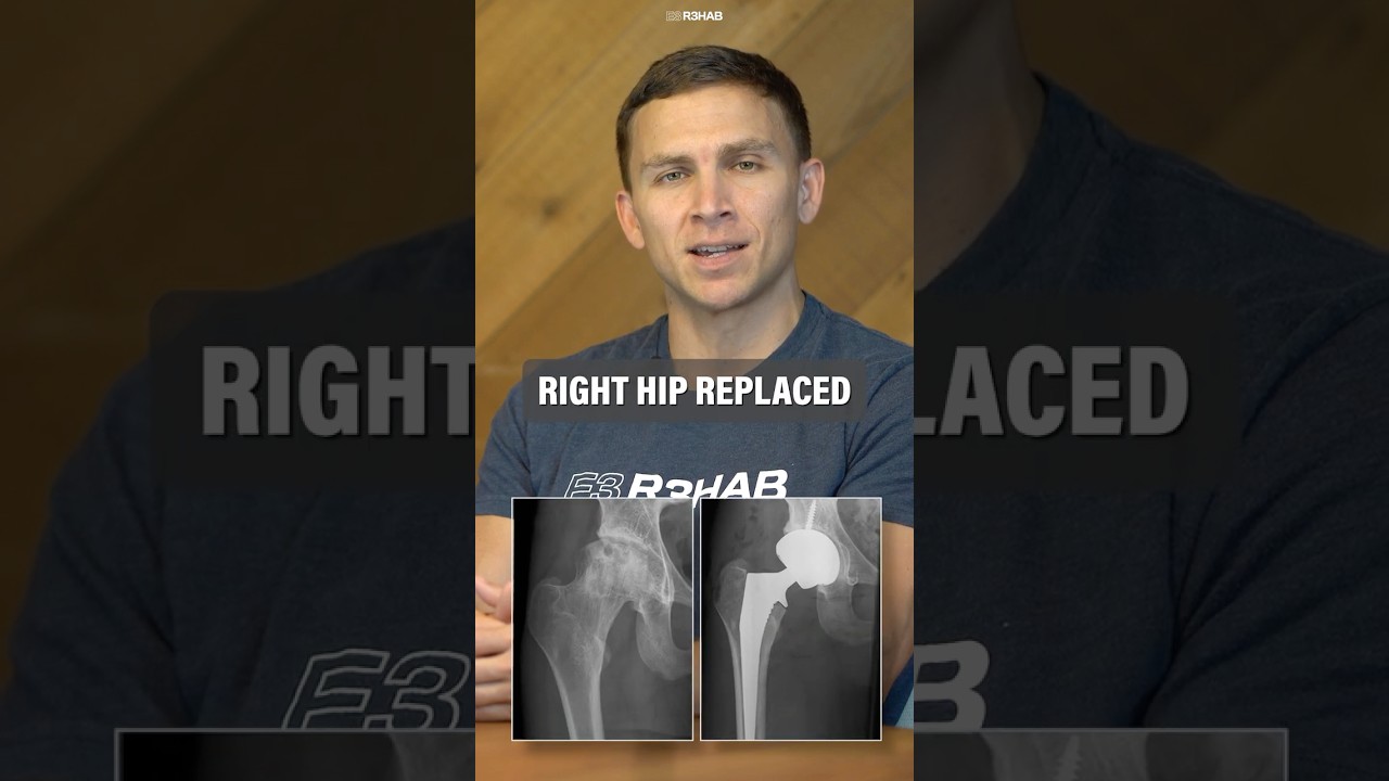 Total Hip Replacement at 19 Years Old #shorts