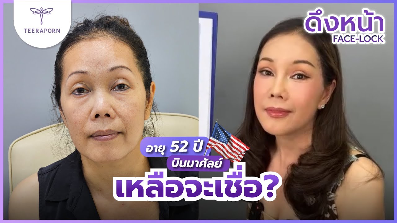ใครจะเชื่อ อายุ 52 ปี หน้าเปลี่ยนมาก ศัลยกรรมดึงหน้า ทำตาสองชั้น เสริมจมูก Facial contourธีรพรคลินิก