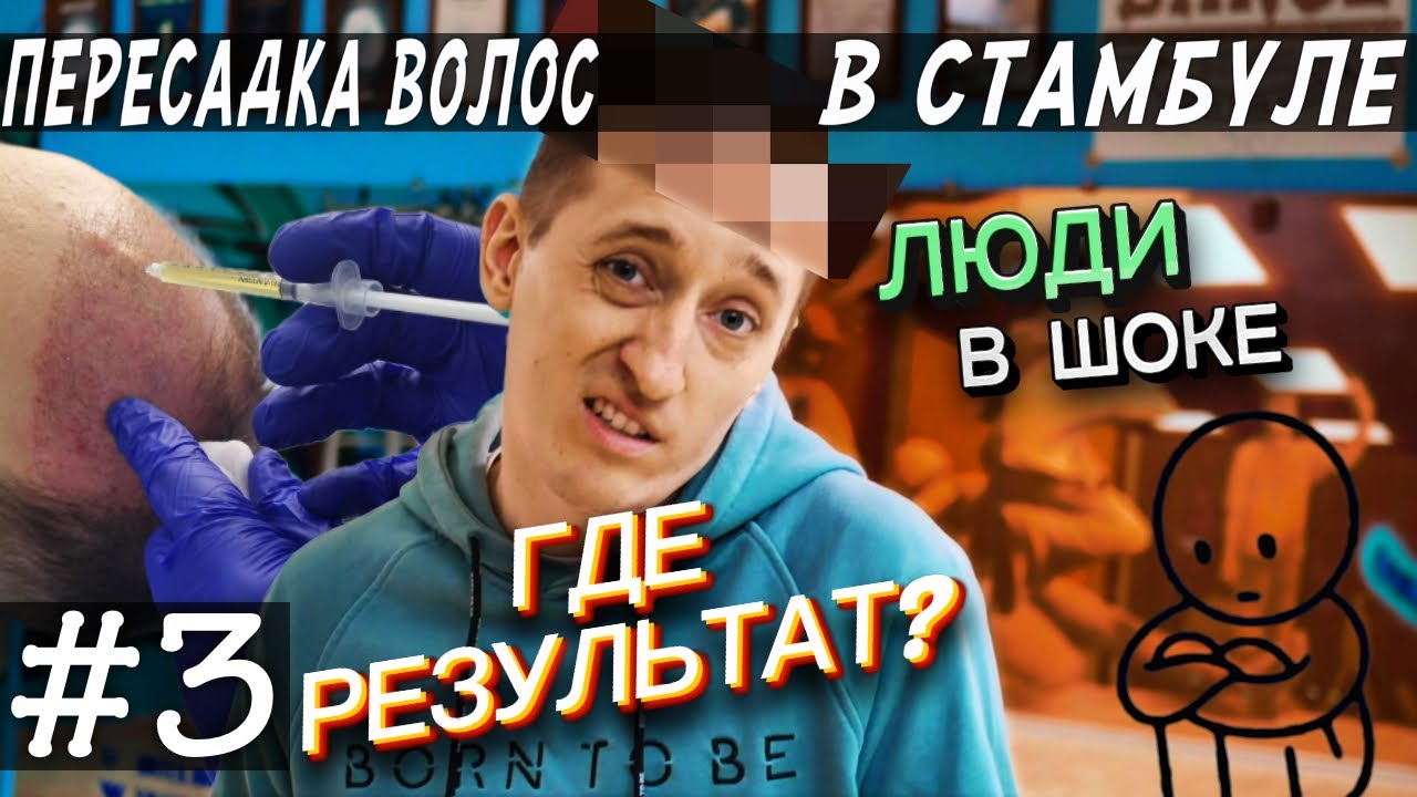 Пересадка волос. Ровно 3 месяца после операции. Где результат?
