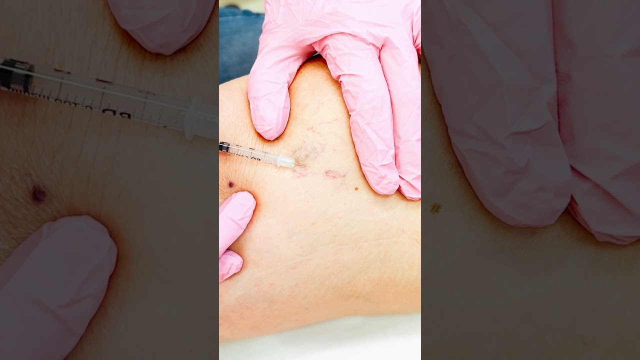 Besenreiser entfernen &ndash; Sanft & effektiv bei Dermacare! 💉✨