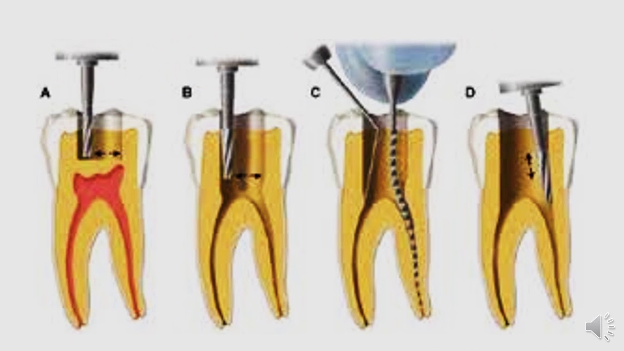 Access Cavity Guide Lines