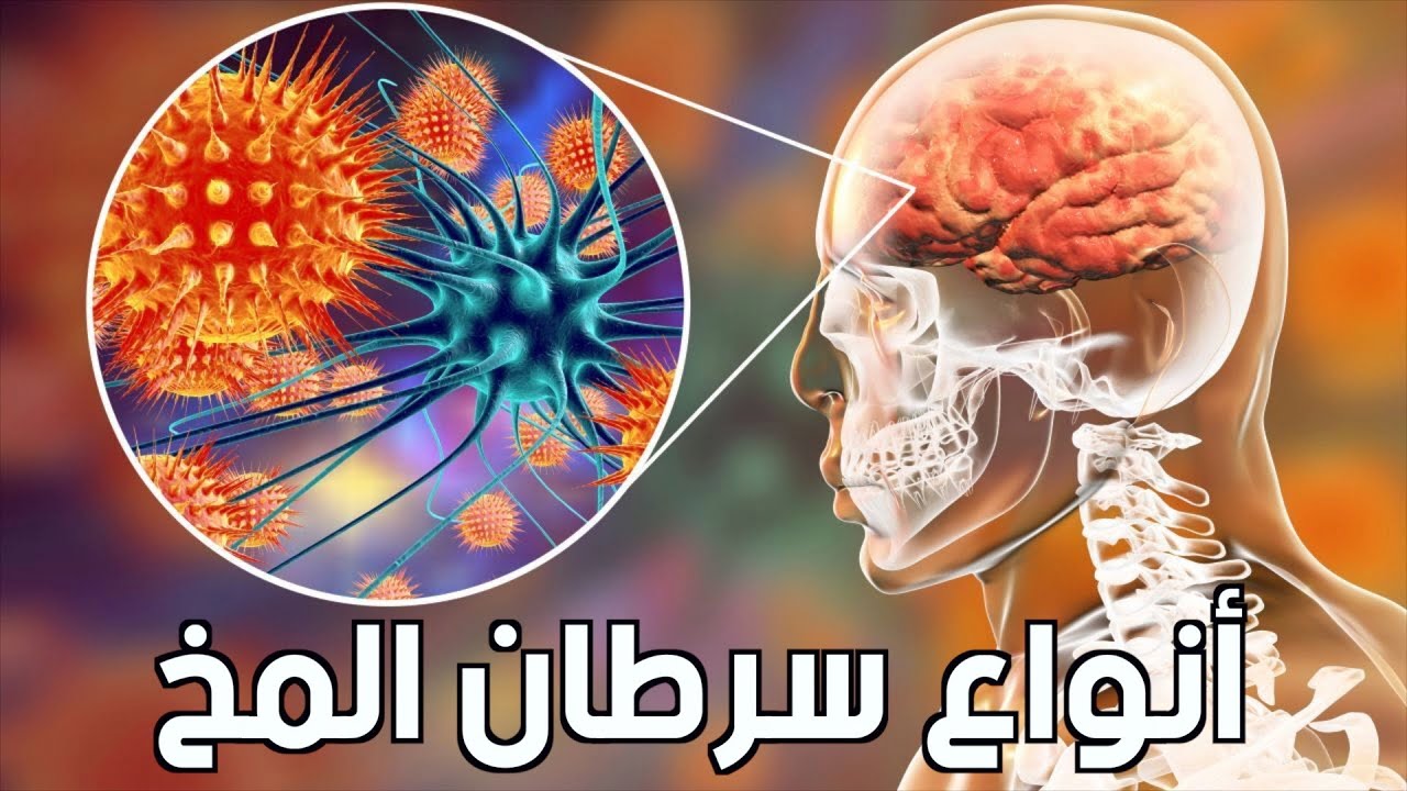 أنواع أورام الدماغ وتصنيفها ومتى تتطلب العلاج الكيميائى ؟