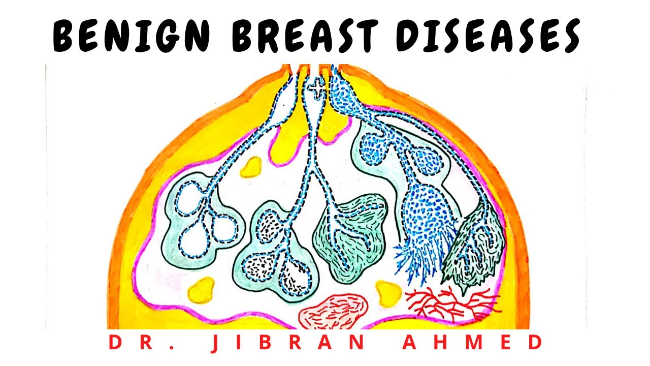 BENIGN BREAST DISEASE