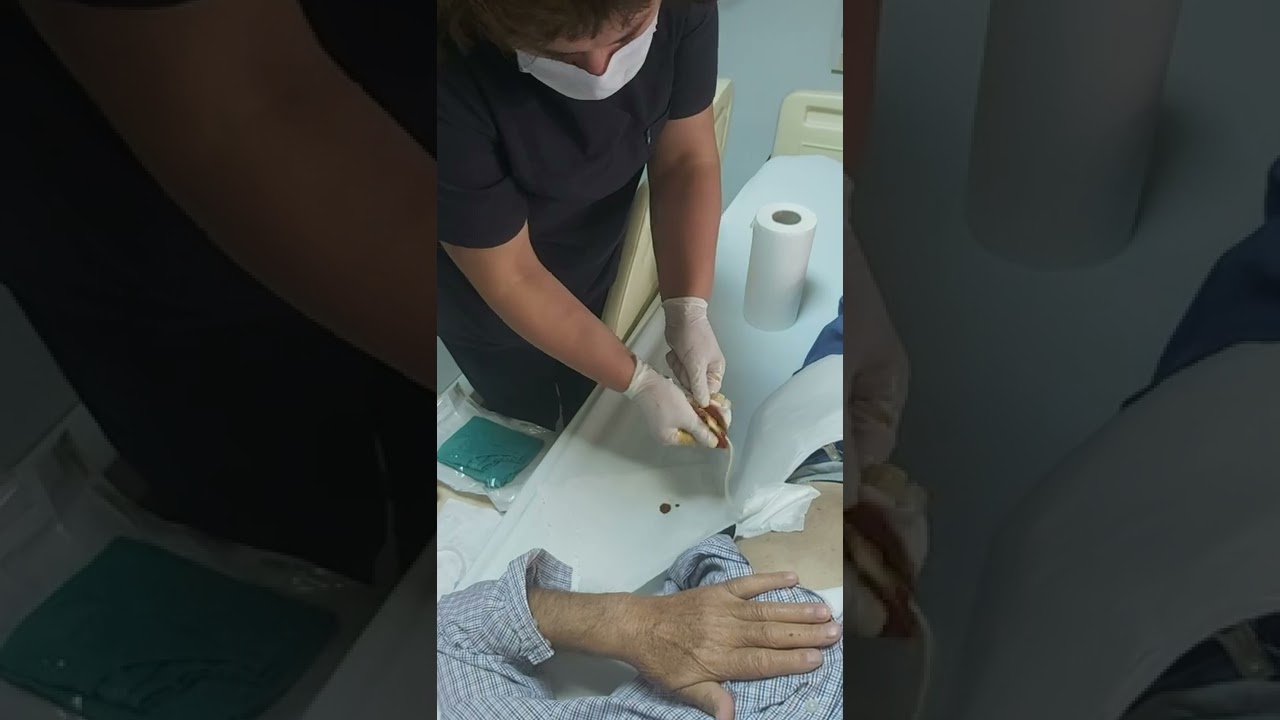 Periton Diyalizi yapan hastada Ultratransfer Set Değişimi nasıl yapılır?