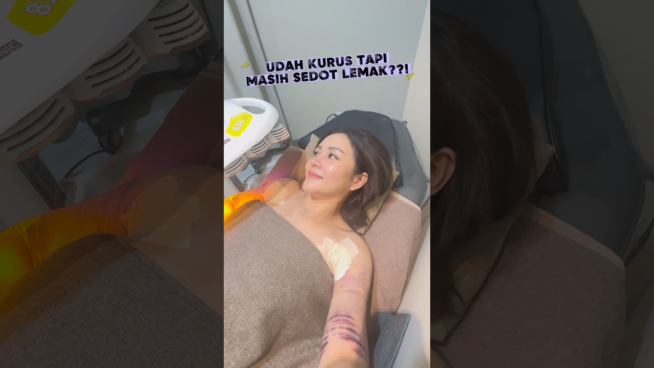 VEVE JAUH-JAUH SEDOT LEMAK KE KOREA?! #liposuction #kbeauty #okayplasticsurgery