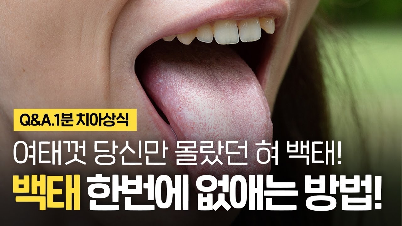 당신만 몰랐던 혀에 백태가 생기는 원인 | 백태 한번에 없애는 법?