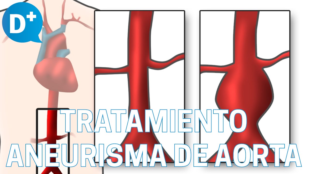 Causas y tratamiento de las Aneurismas de Aorta