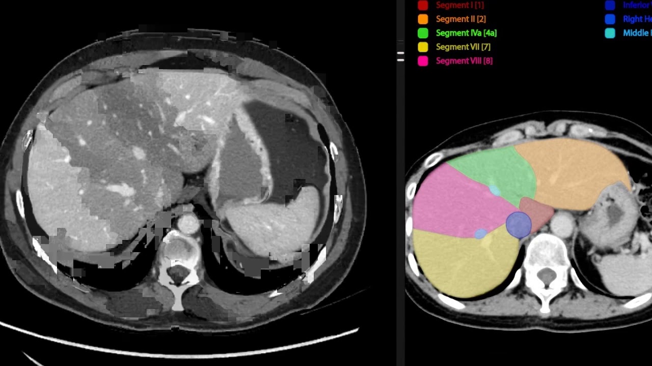 Anatomia de abdomen y pelvis por tomografia computada