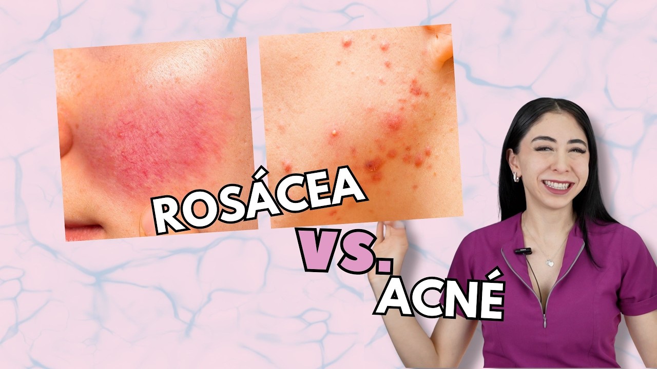 ¿Cómo diferenciar acné de rosácea? 👀💗