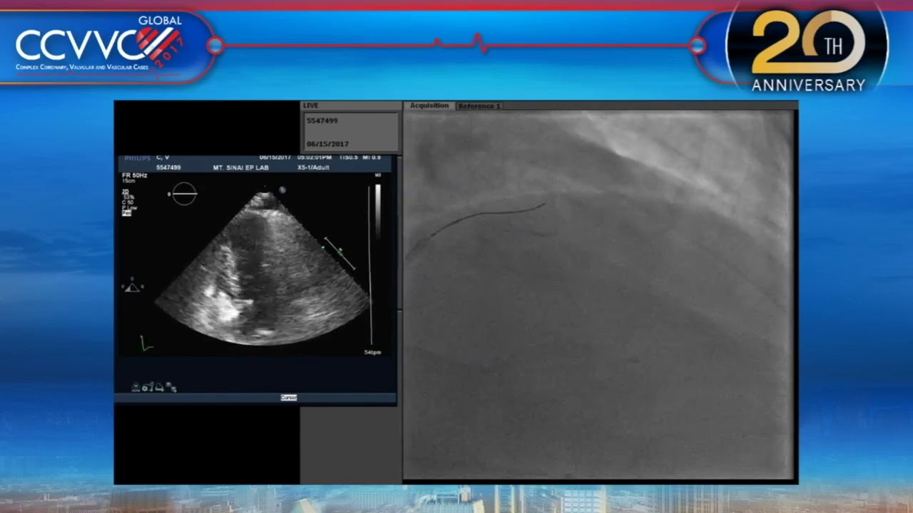 Live Case 14 - Alcohol Septal Ablation under Echo Guidance - CCVVC 2017