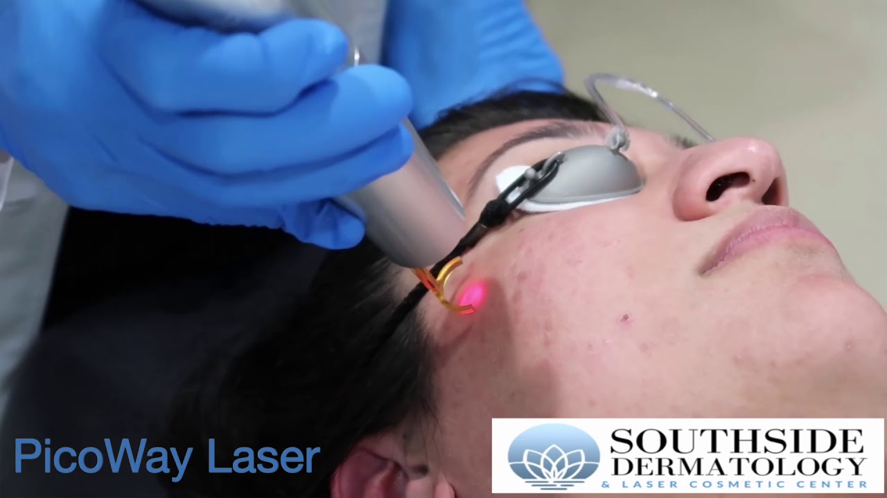 PicoWay Laser Treatment for Acne Scars & Dark Spots