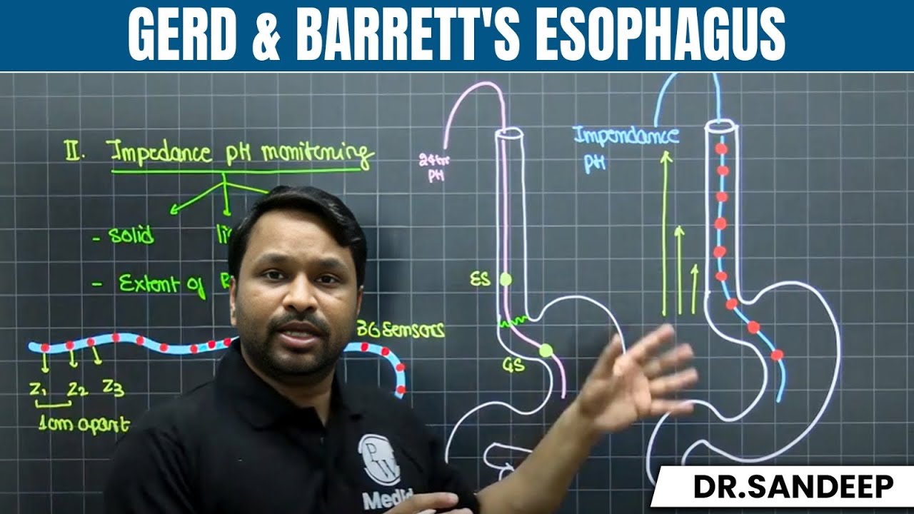 Gerd & Barrett's Esophagus | Lecture of Bailey Learned with Dr. Sandeep 🎉