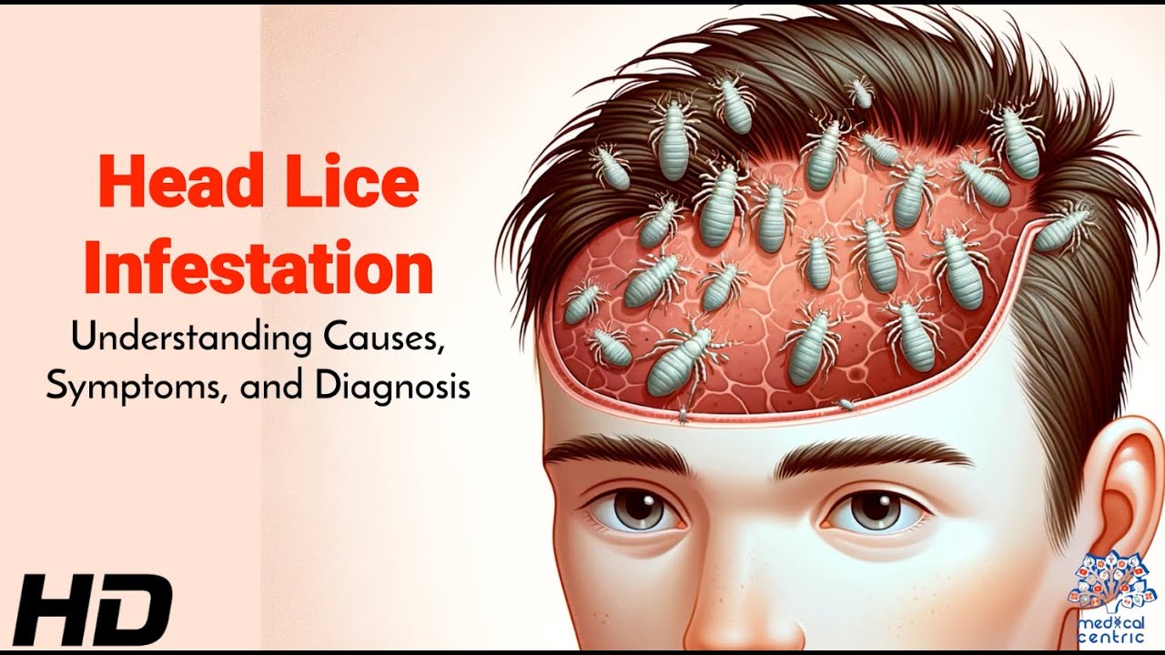 Head Lice Infestation: From Cause to  Cures