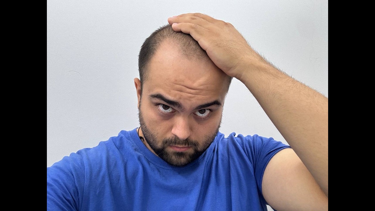 Один год боролся с облысением - что вышло?
