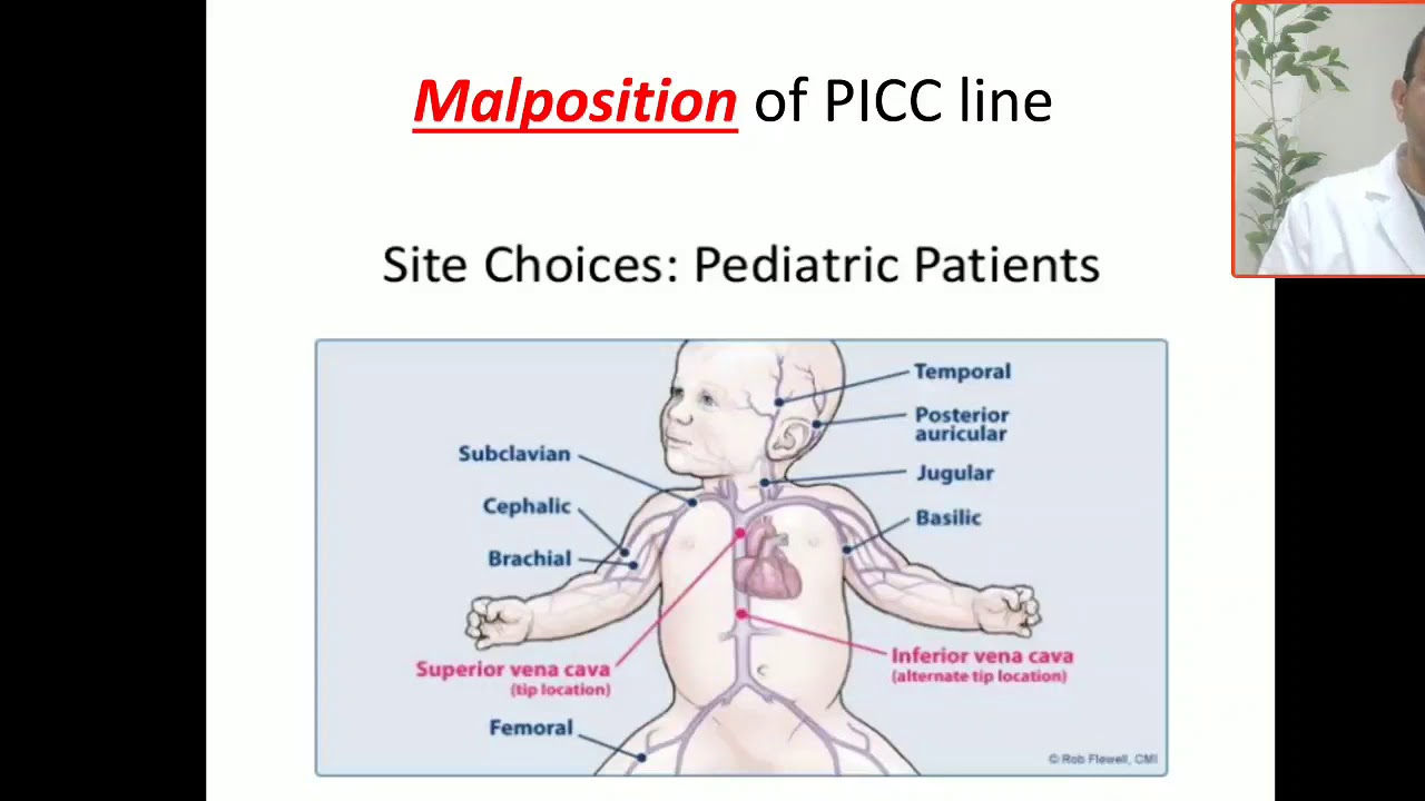 Case 30 PICC LINE  malposition,  in left atrium,  approach for insertion of PICC LINE