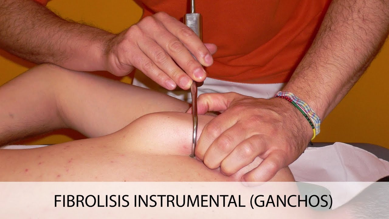 Fibrolisis instrumental (ganchos) - Fisiofocus