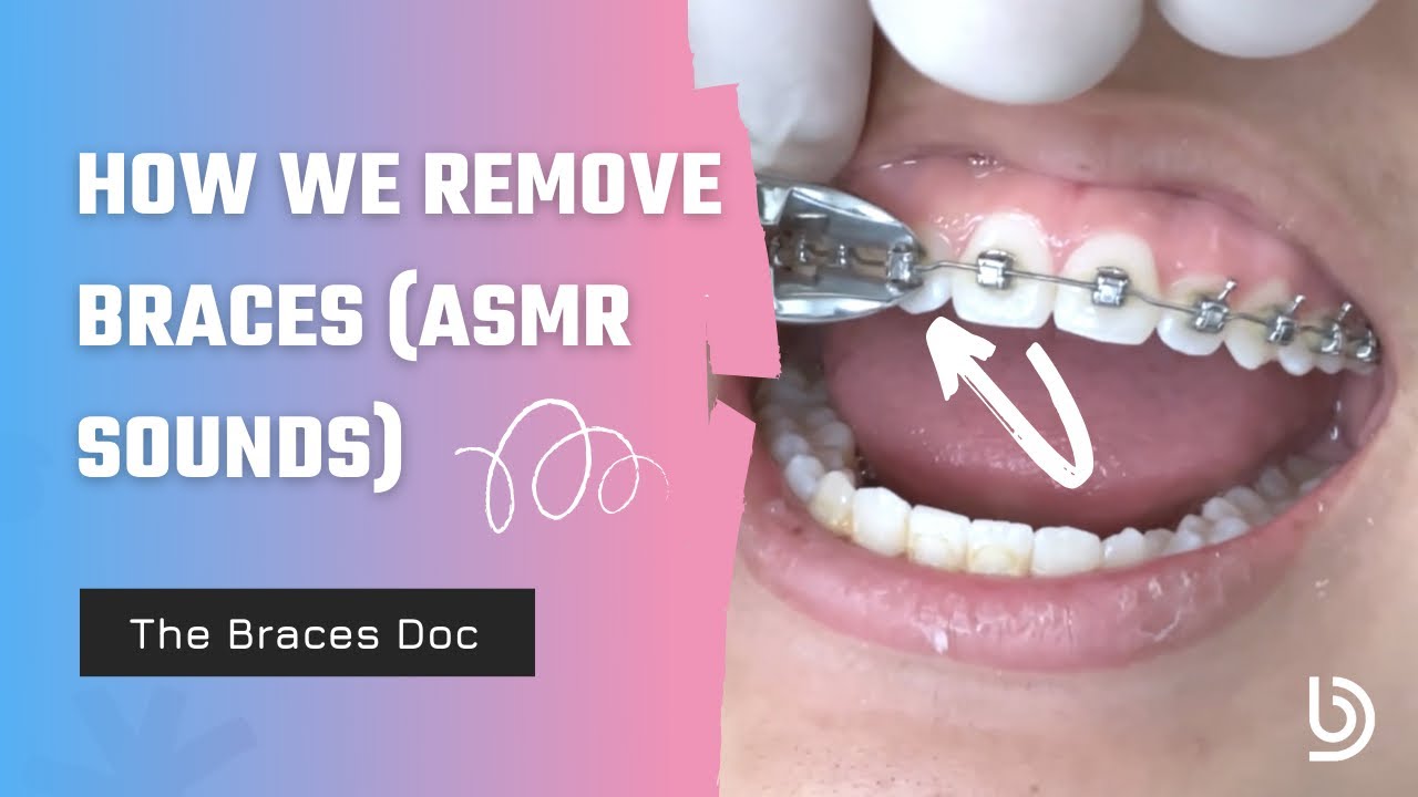 Satisfying Braces Removal w/ The Braces Doc (ASMR) &mdash; How we remove braces