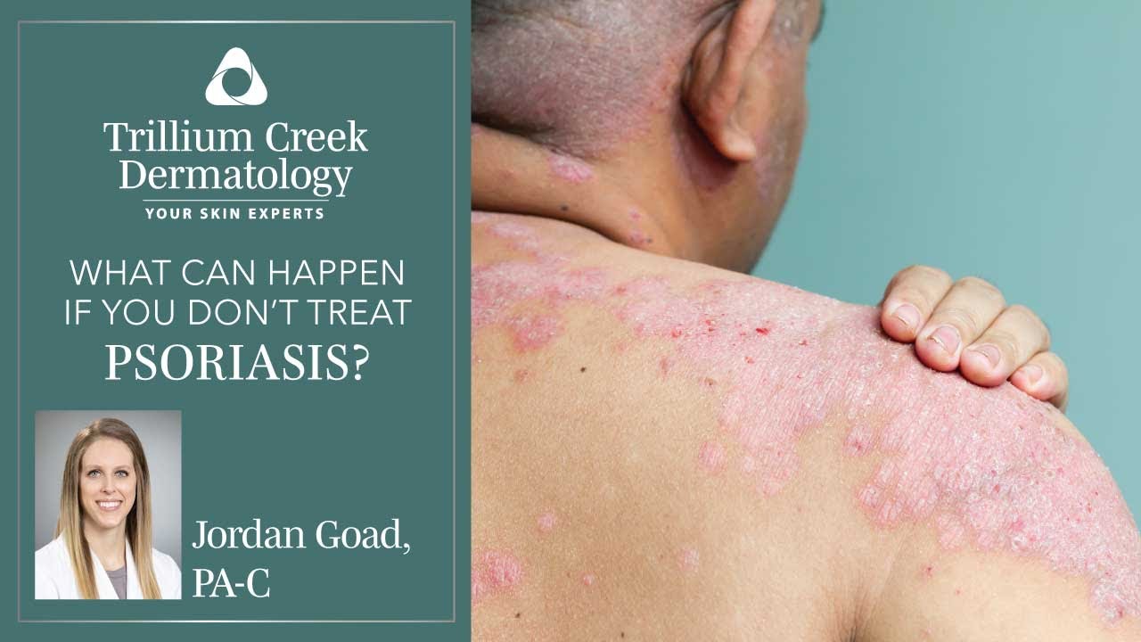 What happens if psoriasis is untreated?
