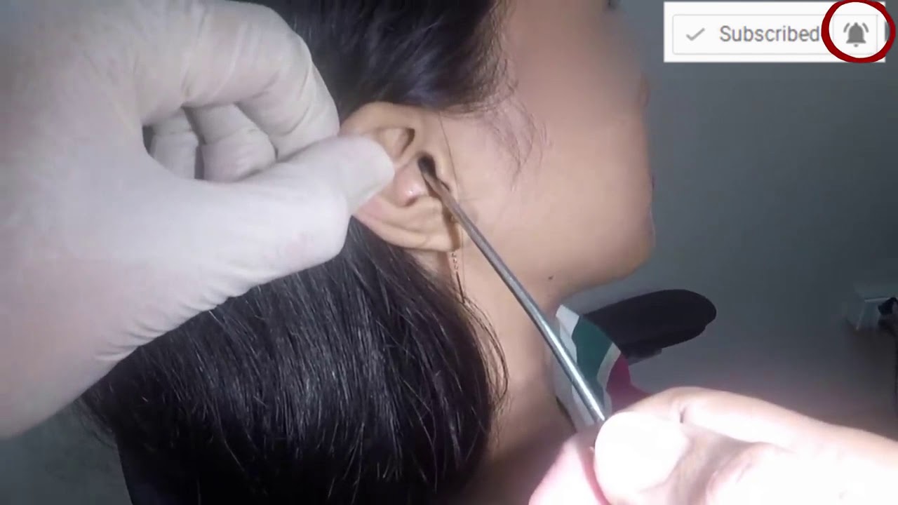 College Girl Huge Wax Blockage!  Earwax Specialist