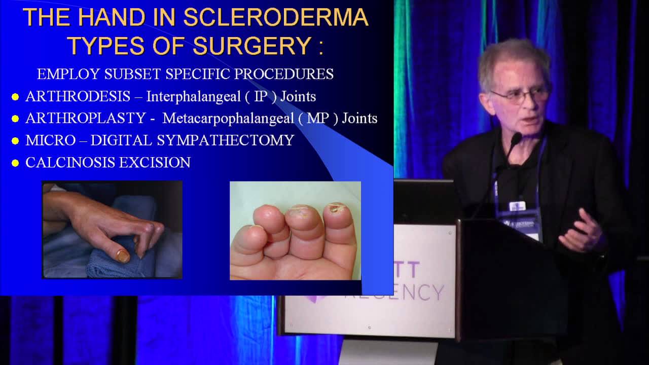 2013 Atlanta - The Hand In Scleroderma: Surgical Options - Dr. Charles Melone