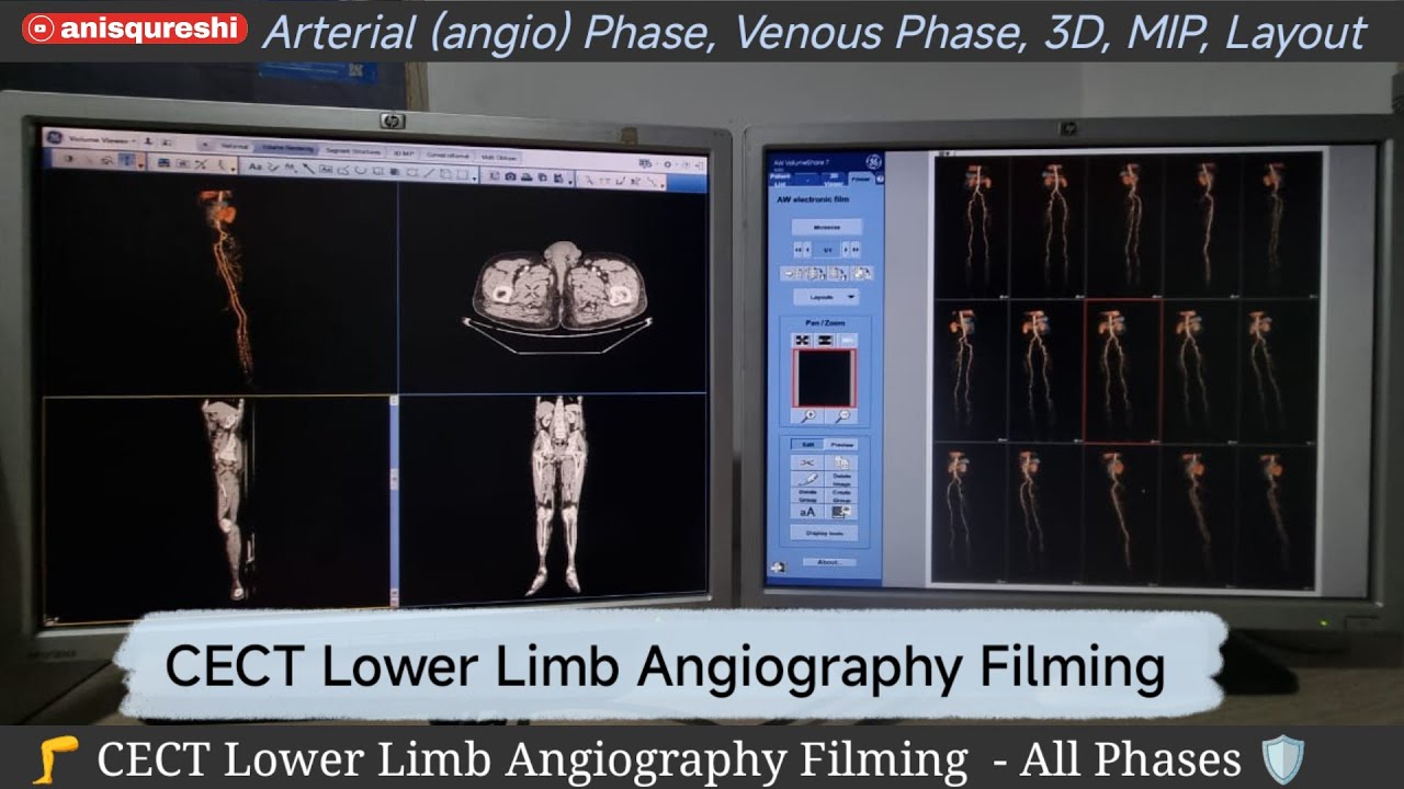 Filming | CECT Lower Limb Angiography| By Anis Qureshi 
