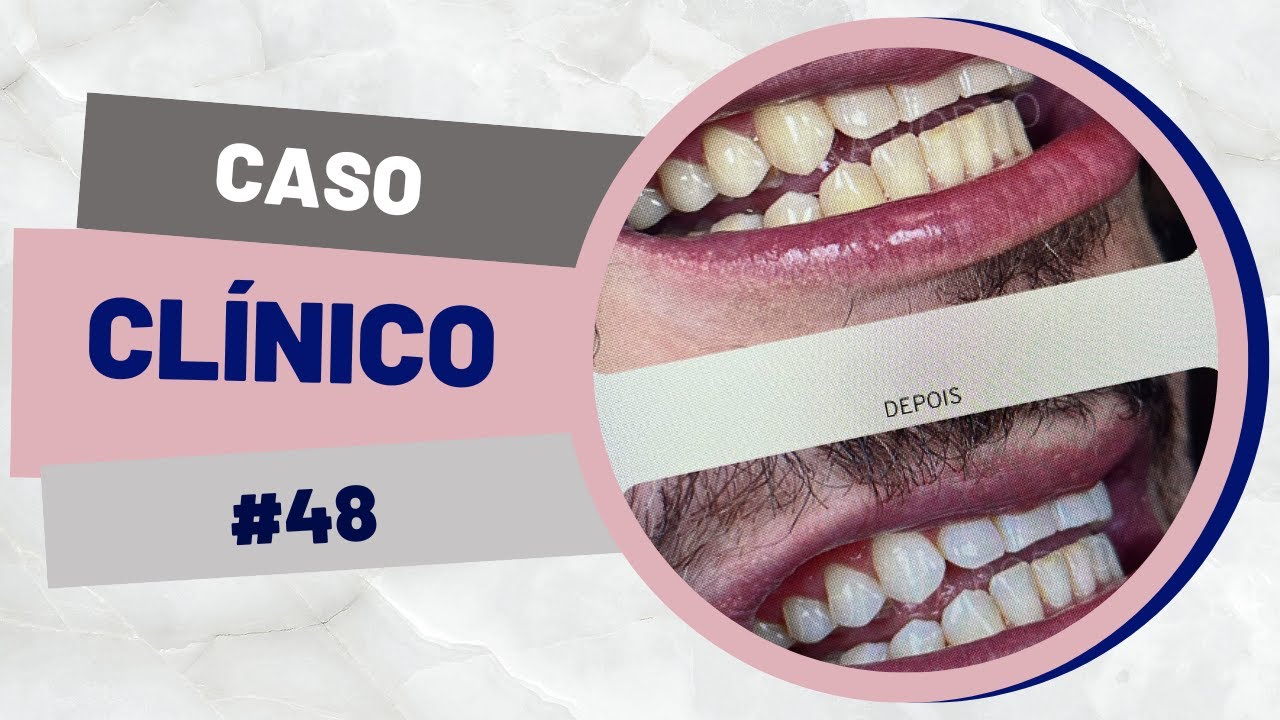 Caso clínico de clareamento | Indiara Dentista #48