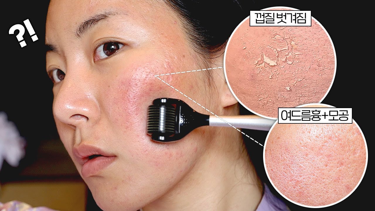 심한 모공+여드름흉 피부...MTS 한달동안 해봄🔥 내돈내산 솔직 리뷰!! (부작용, 효과, 주기)