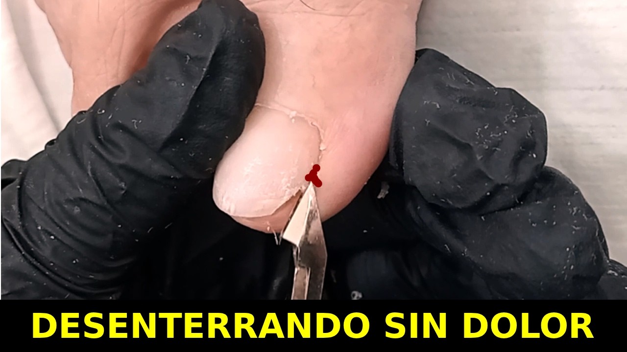 ¡¡Como desenterrar uñas sin nada de dolor!!!