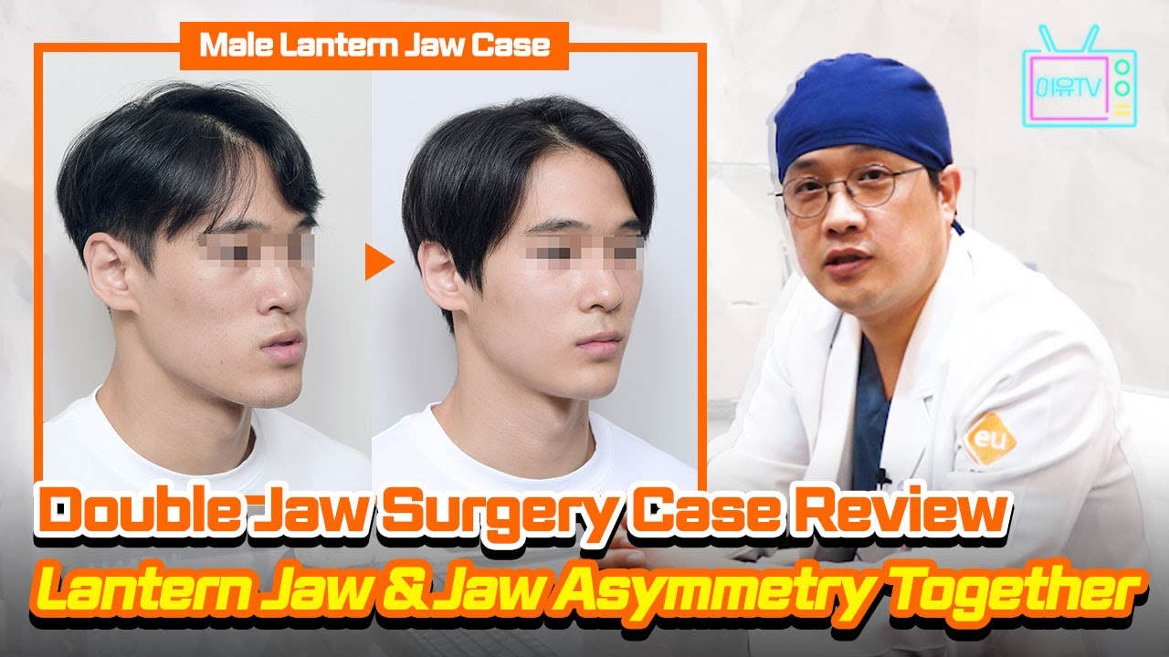 [EN/JP/TH/ SUB] Korean Male Double Jaw Surgery Case Review