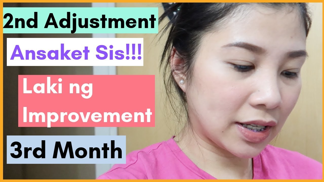 2nd Adjustment ng braces | Nilagyan ako ng Chain | Braces Journey