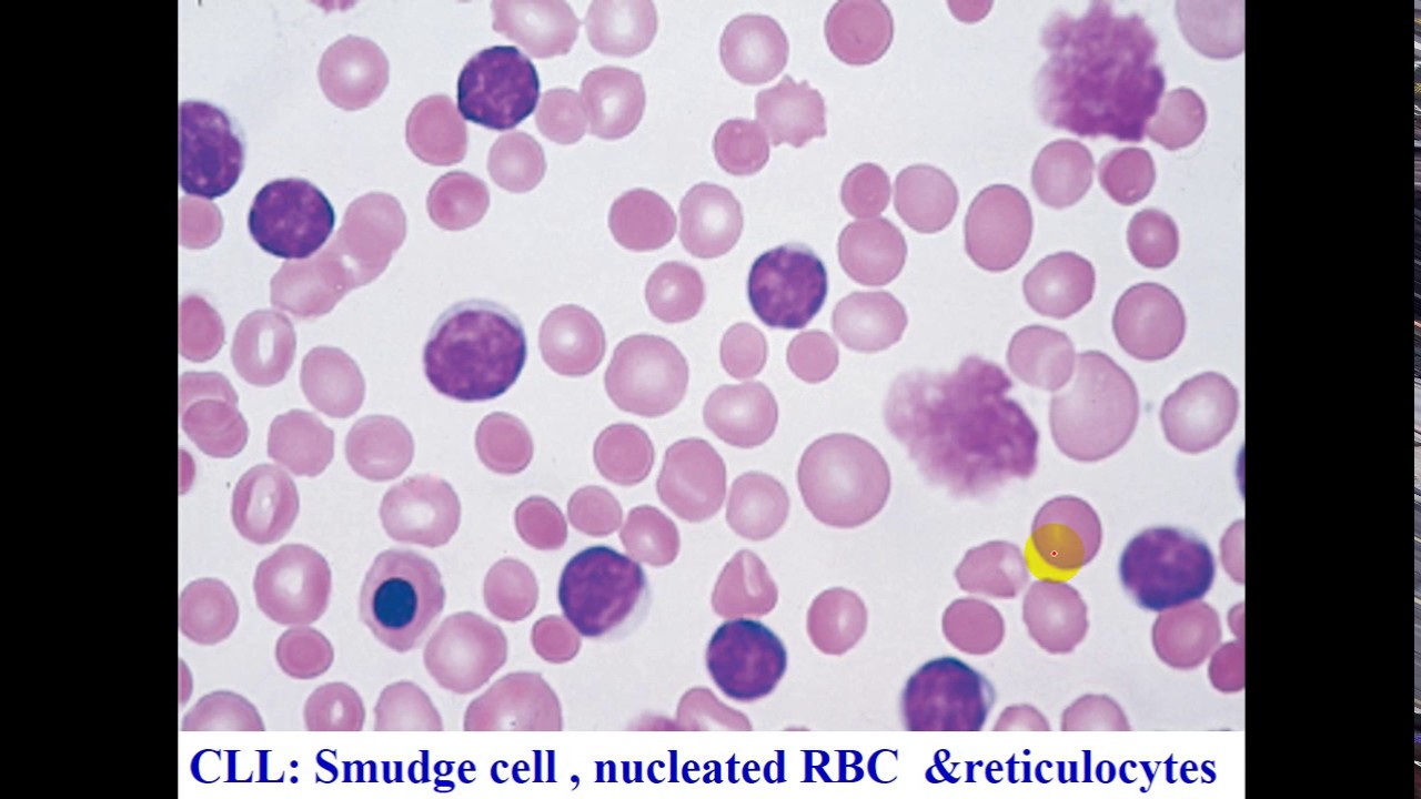 Pathology -- dr. Nafe'a -- Non Hodgkin lymphomas أورام
