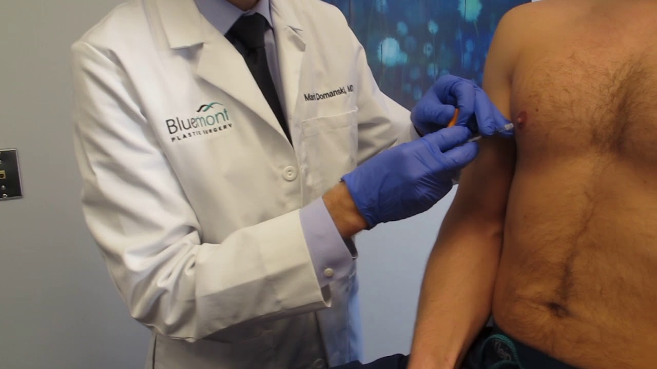 Prominent Male Nipples treated with Dysport!