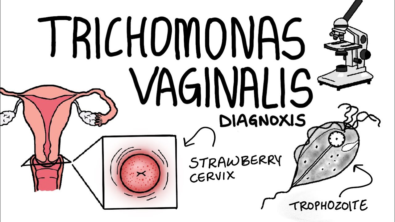 Trichomonas vaginalis- Microbiology(morphology,lifecycle,clinical features,lab diagnosis, treatment)