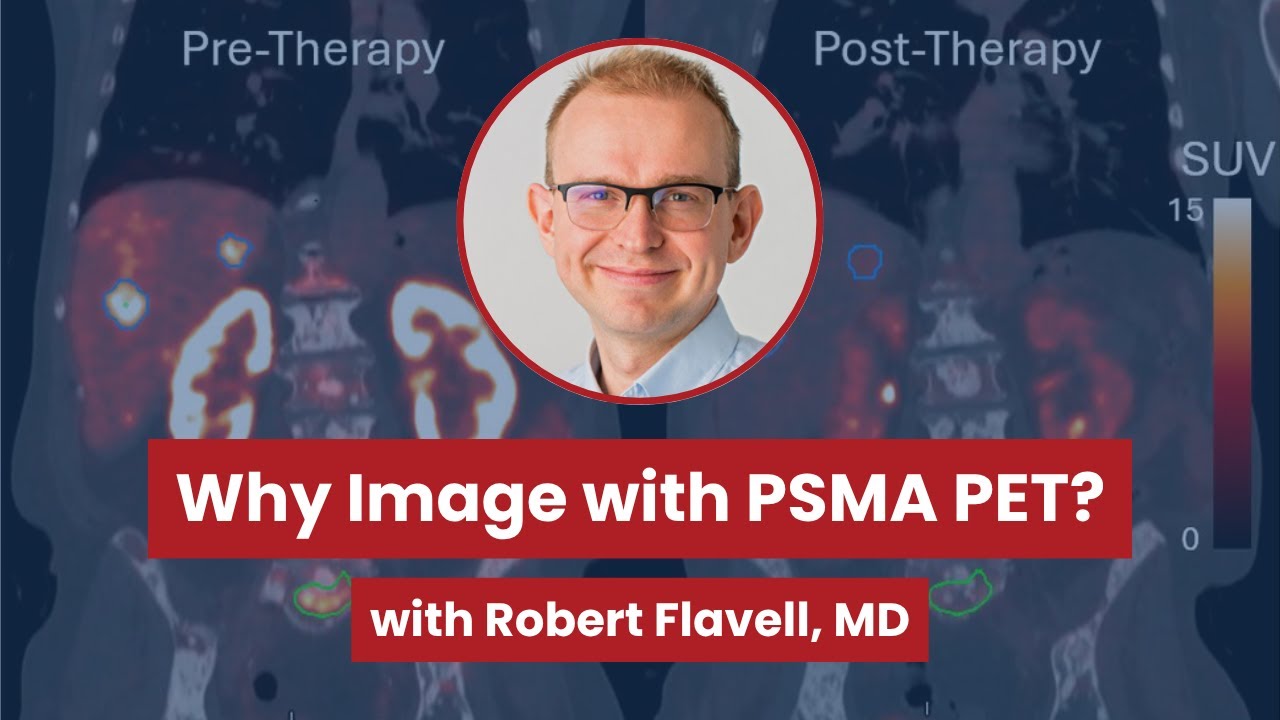 Visualizing Prostate Cancer: Why Image with PSMA PET?