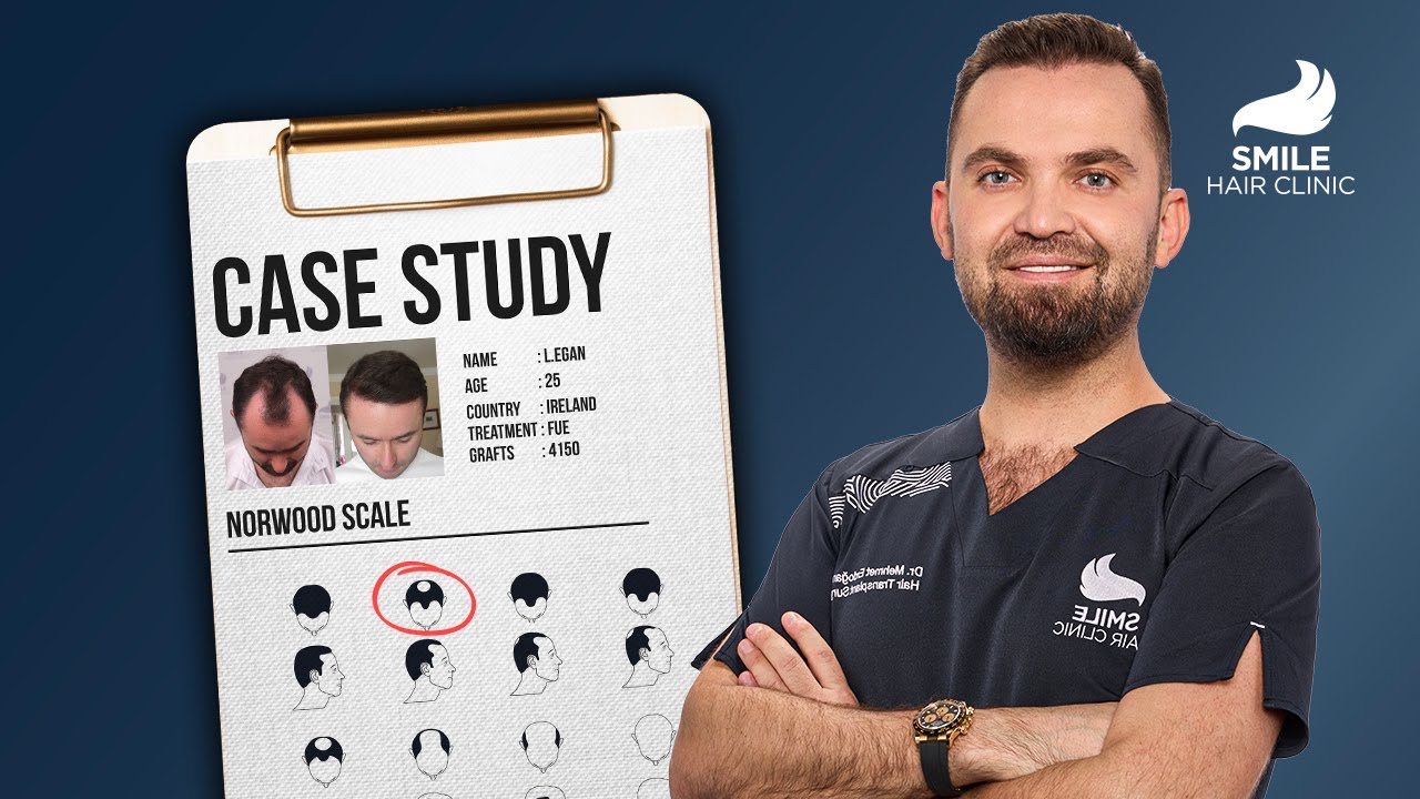Transformative Hair Journey | Dr. Mehmet Erdoğan’s 4150 Graft Case Study – Stunning 12-Month Result!