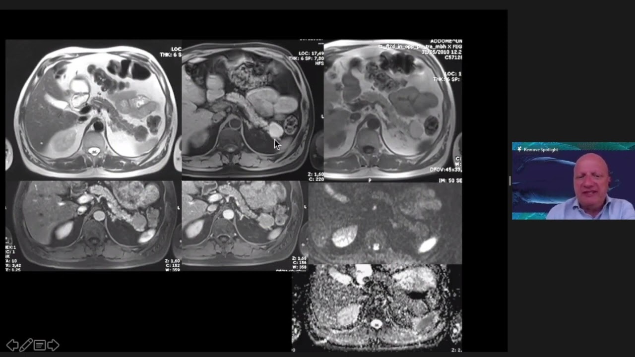 Pancreatic cystic lesions by Dr Gianni Morana