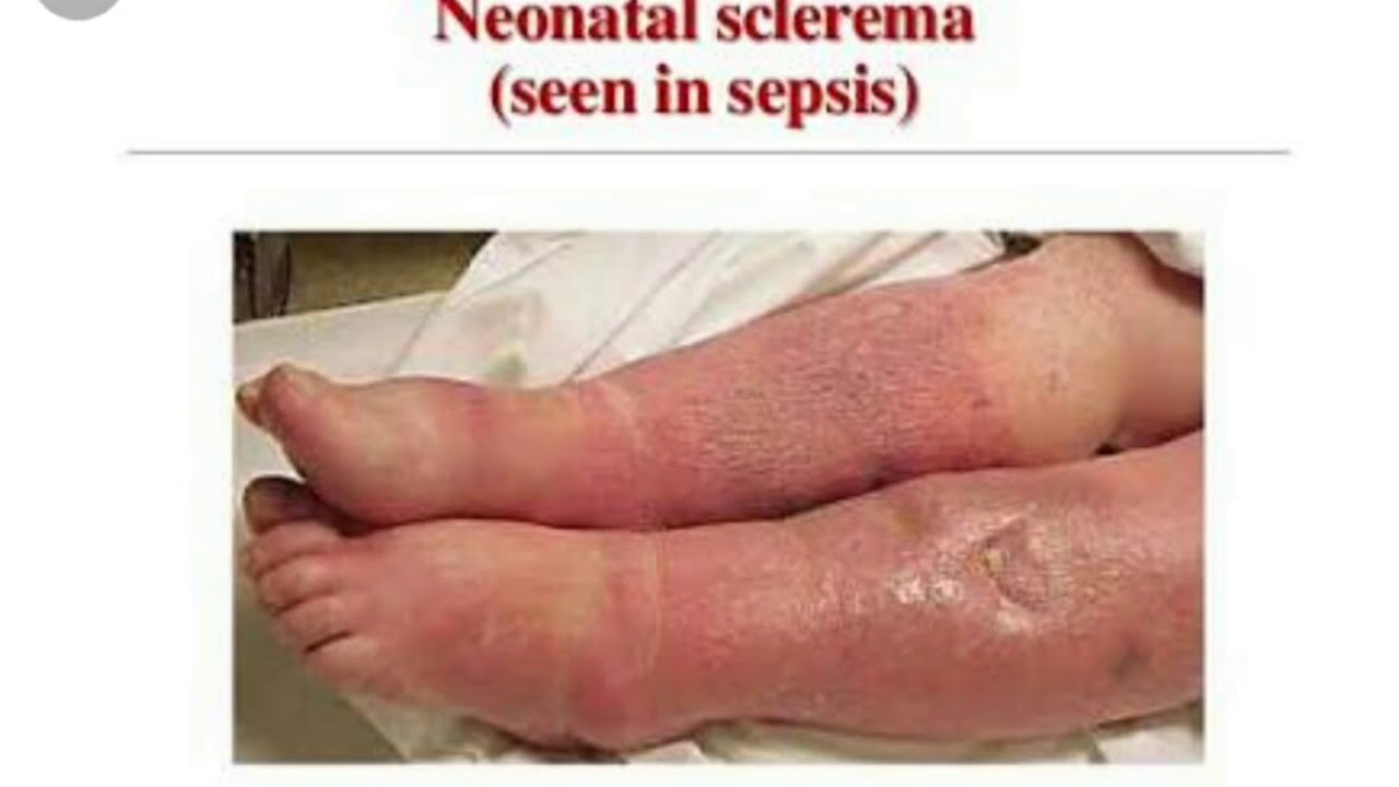 Neonatal sepsis-clinical feature, definition etiology