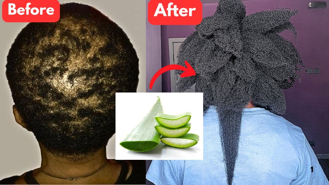 SHOCKING! USE THIS AND YOUR HAIR WILL NEVER STOP GROWING! Aloe Vera for Massive Hair Growth!