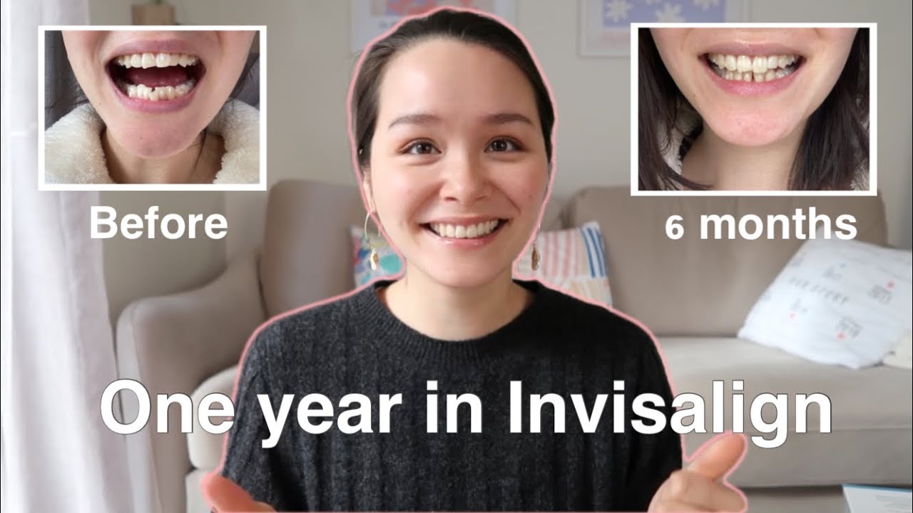 One year in Invisalign update!