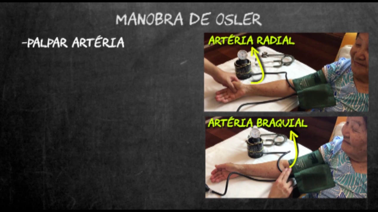 Pseudo-hipertensão e a manobra de Osler