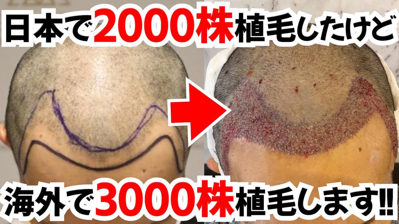 【トルコ植毛】日本で2000株、海外で3000株植毛しました！【薄毛｜AGA｜ハゲ｜自毛植毛】