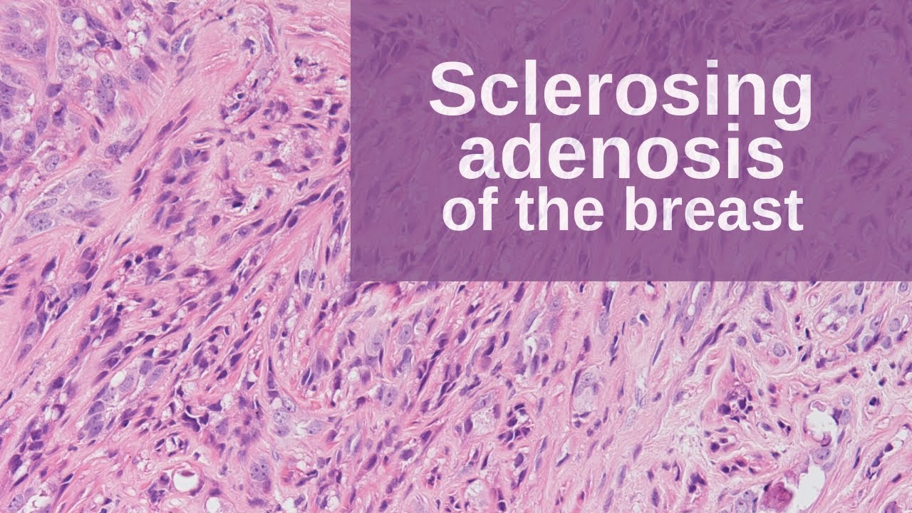 Sclerosing Adenosis of the Breast - Pathology mini tutorial