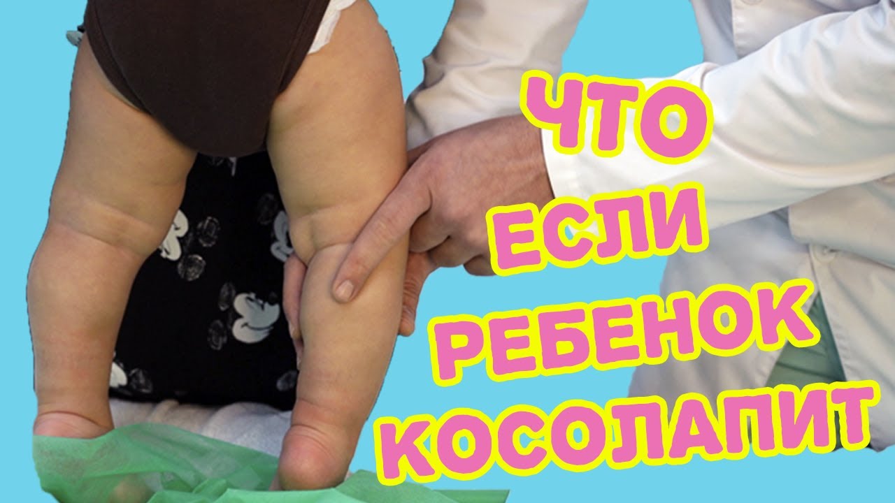 Ребенок косолапит. О-образные ноги. (Варус ног)