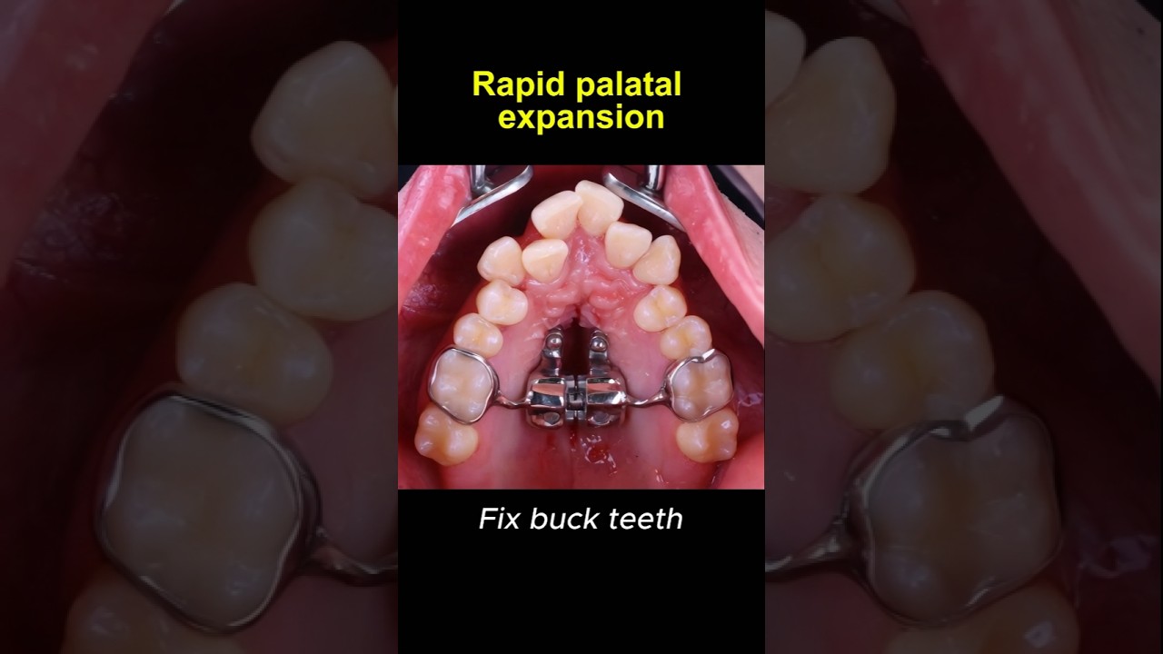 Expand upper teeth with rapid palatal expander #braces #orthodontist #dentist