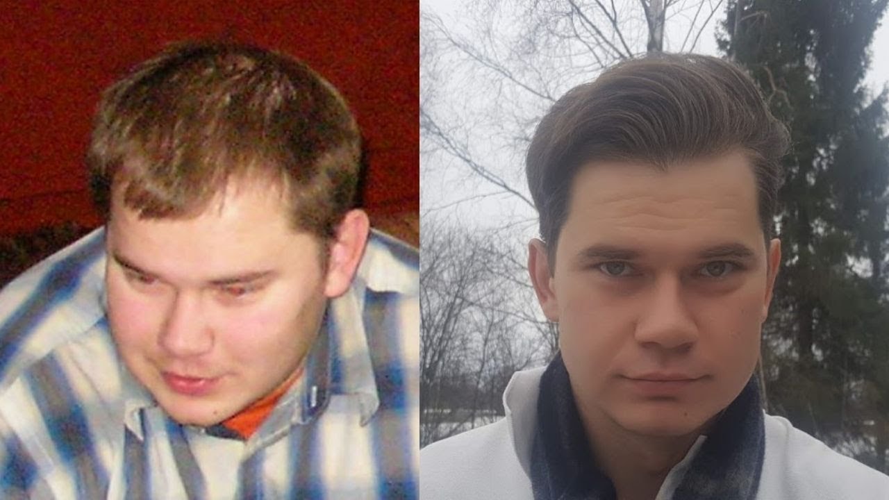 Hair Loss | Shedding And Steps To Stop It